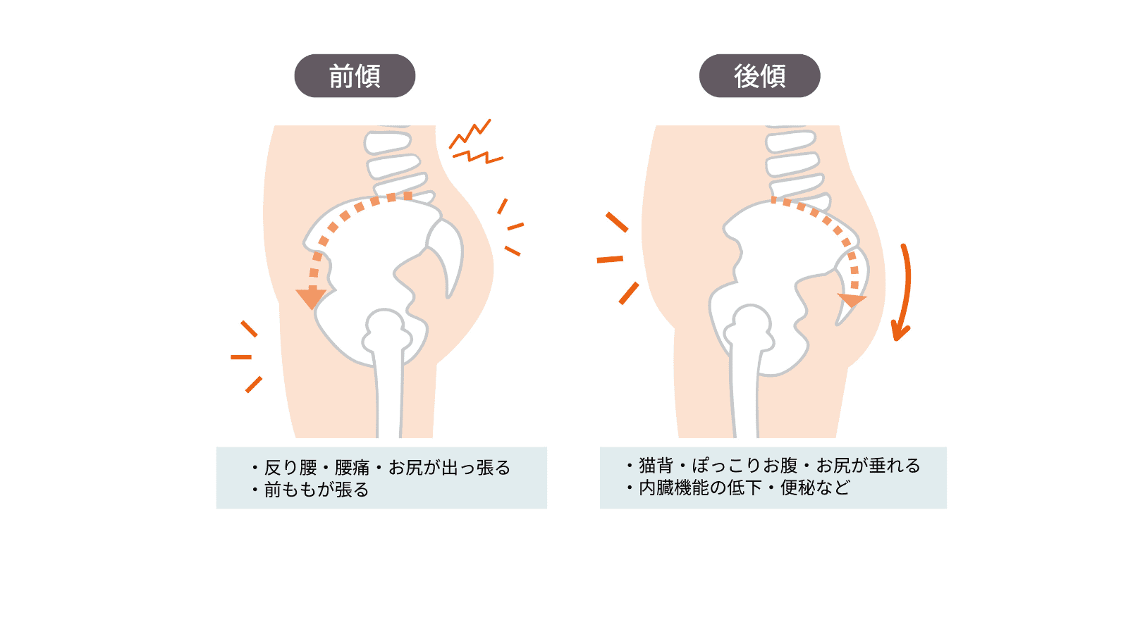 骨盤の歪み
