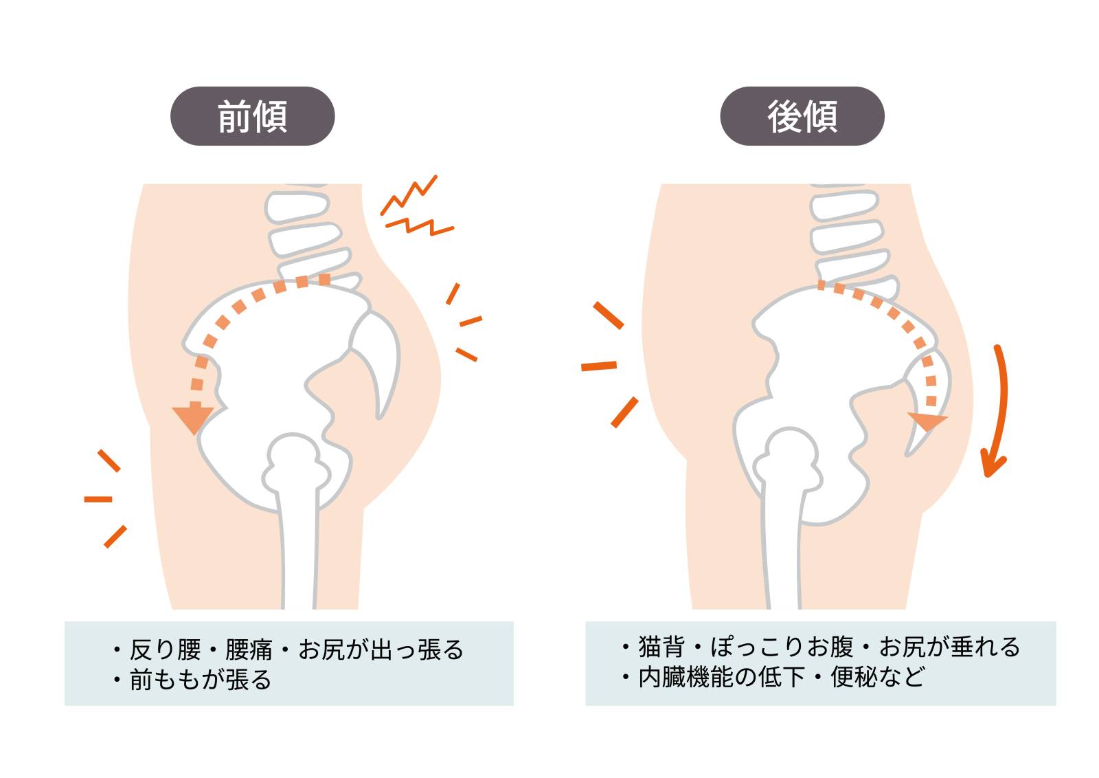 骨盤の歪みのイメージ