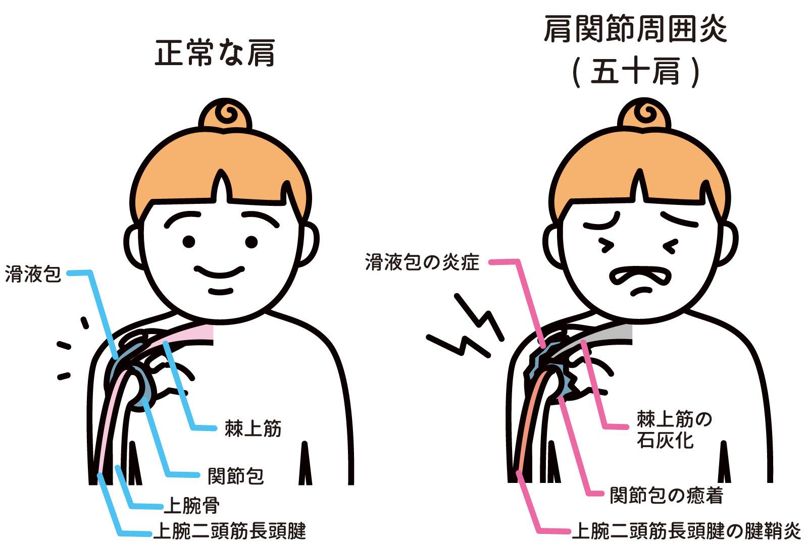 五十肩