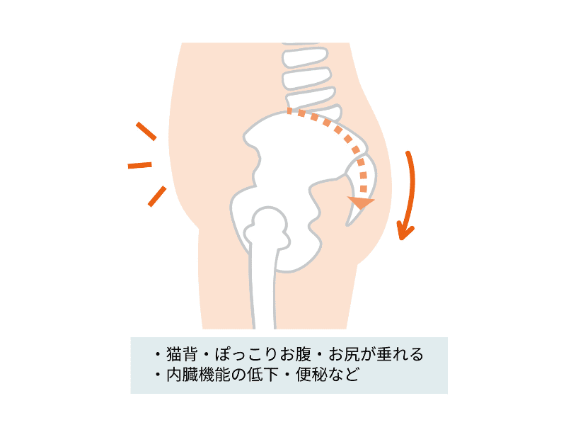 骨盤後傾