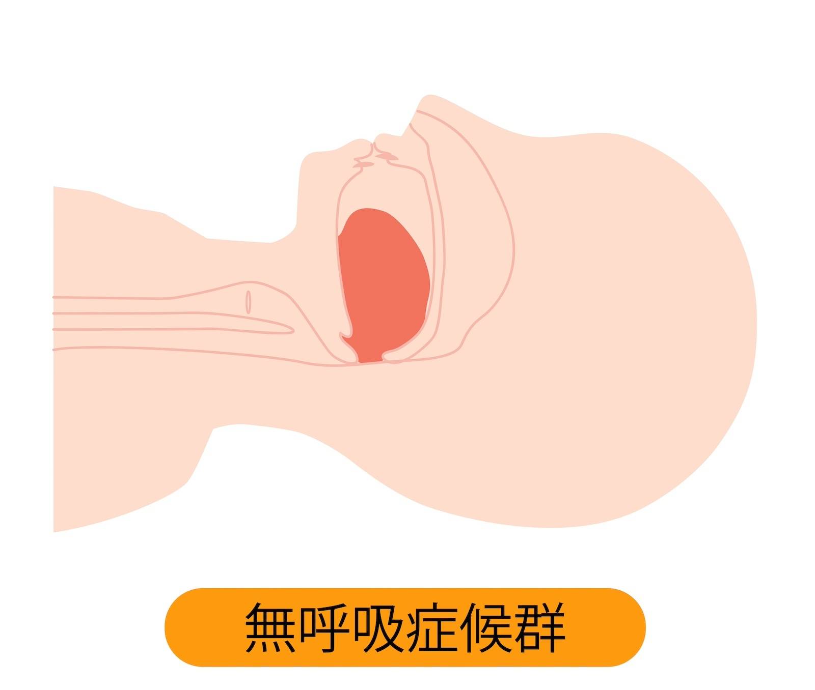 睡眠時無呼吸症候群