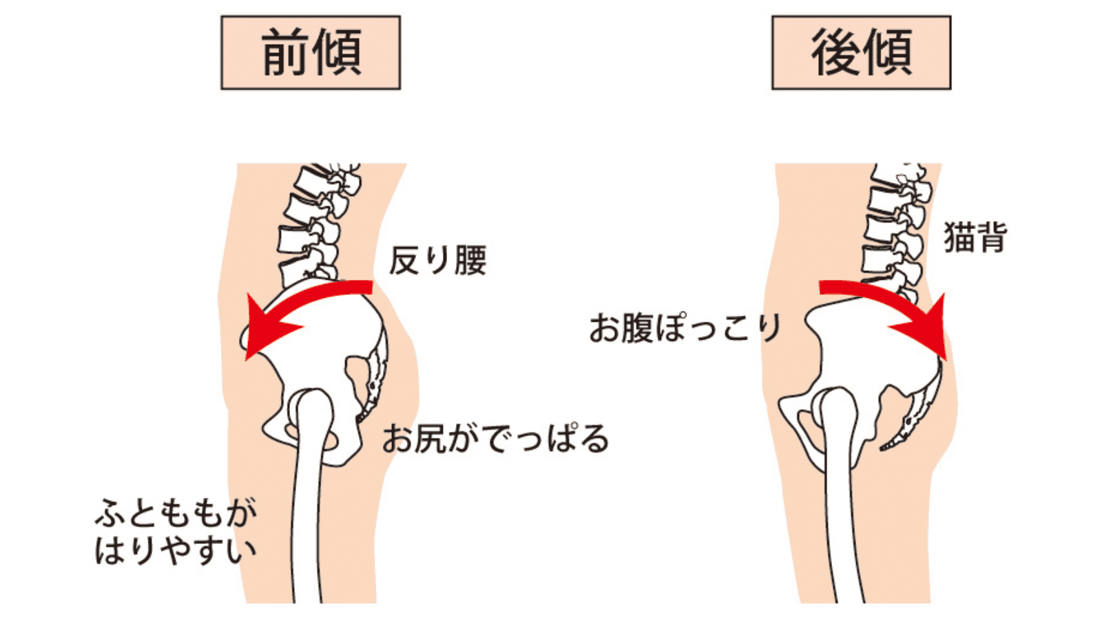 骨盤の歪み