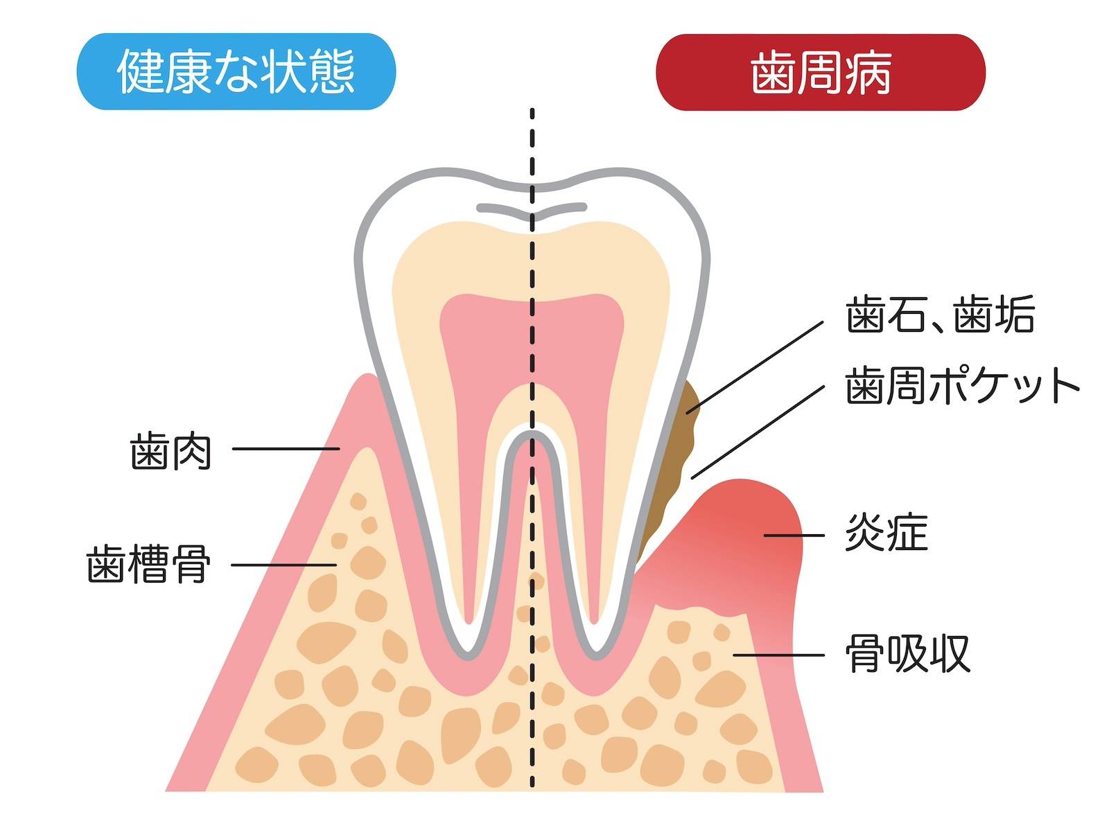 歯周病