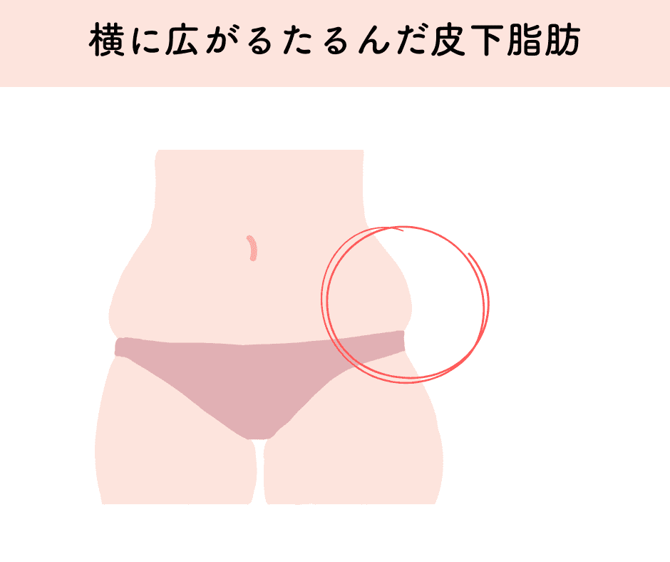 皮下脂肪