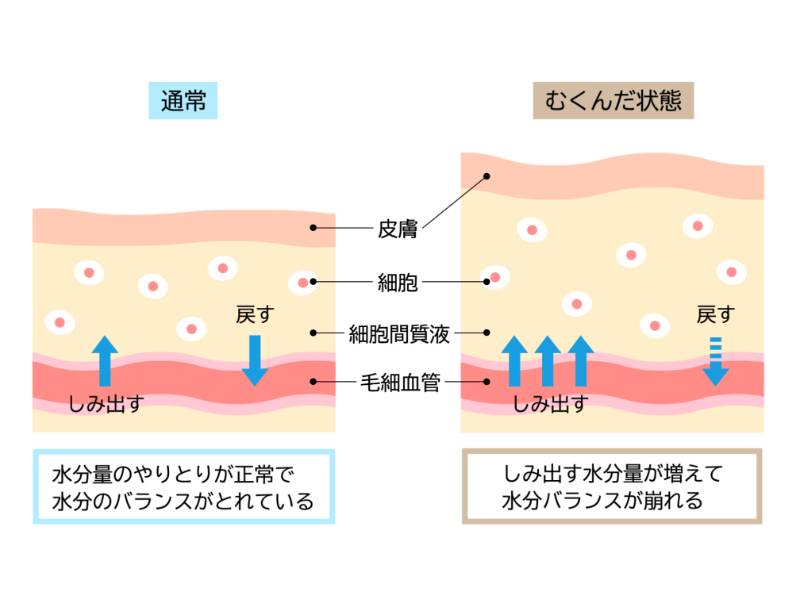 むくみのメカニズム