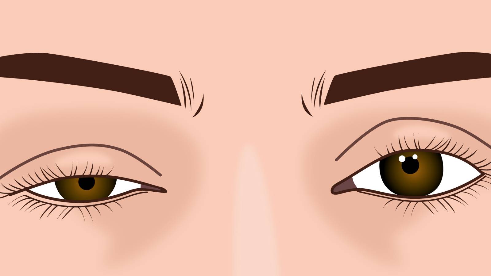 まぶたが下がってくる〈眼瞼下垂〉治療せずに放置するとどうなる？見た目だけじゃない影響は｜医師解説