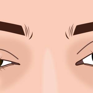 まぶたが下がってくる〈眼瞼下垂〉治療せずに放置するとどうなる？見た目だけじゃない影響は｜医師解説