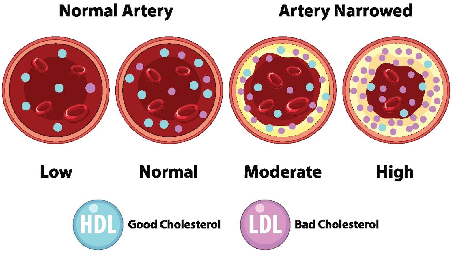 悪玉コレステロール、なぜ悪い？コレステロール値が高い人が意識すべき食事のポイント｜管理栄養士解説