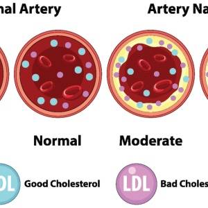 悪玉コレステロール、なぜ悪い？コレステロール値が高い人が意識すべき食事のポイント｜管理栄養士解説