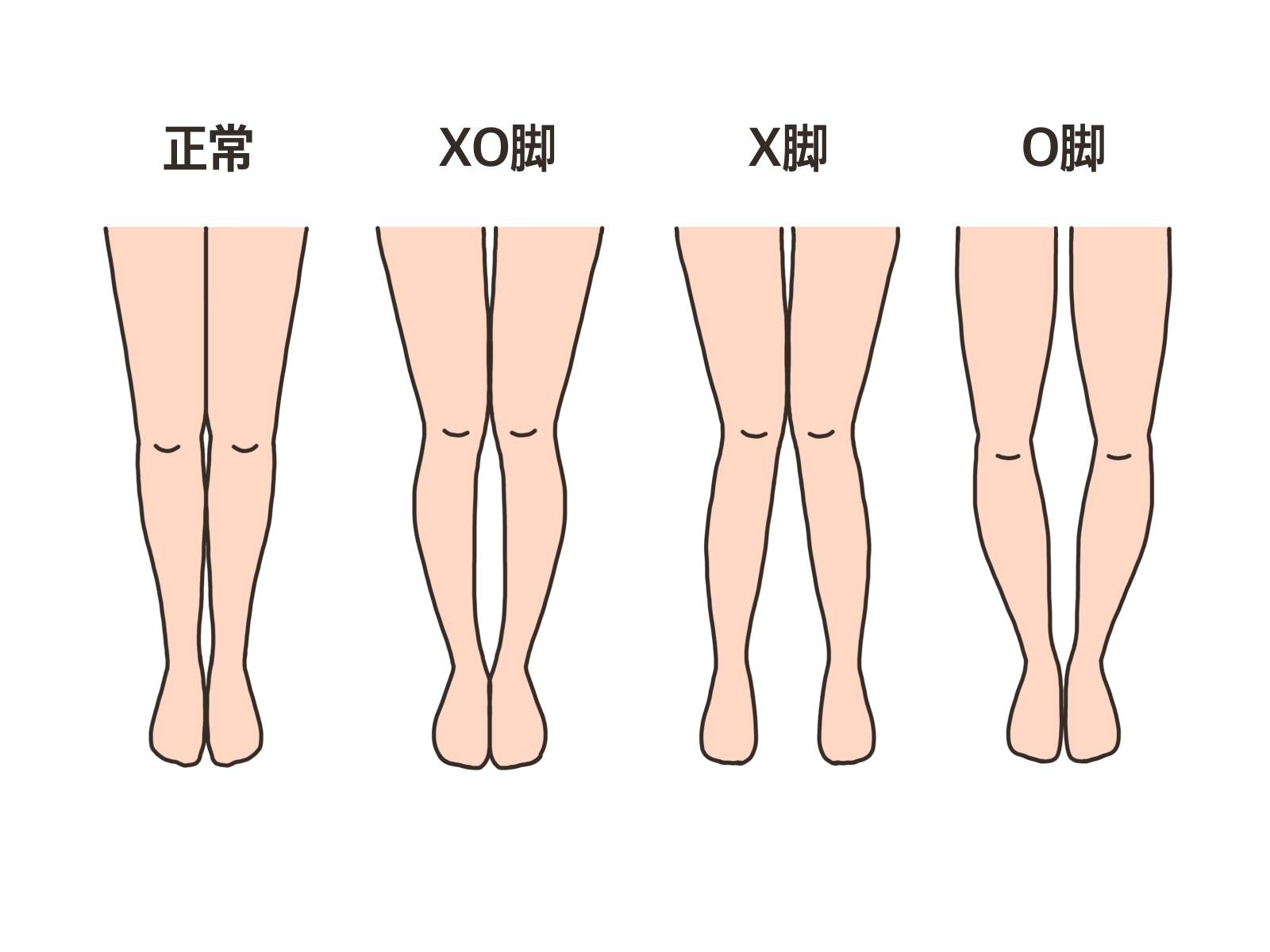 脚の歪みのイメージ