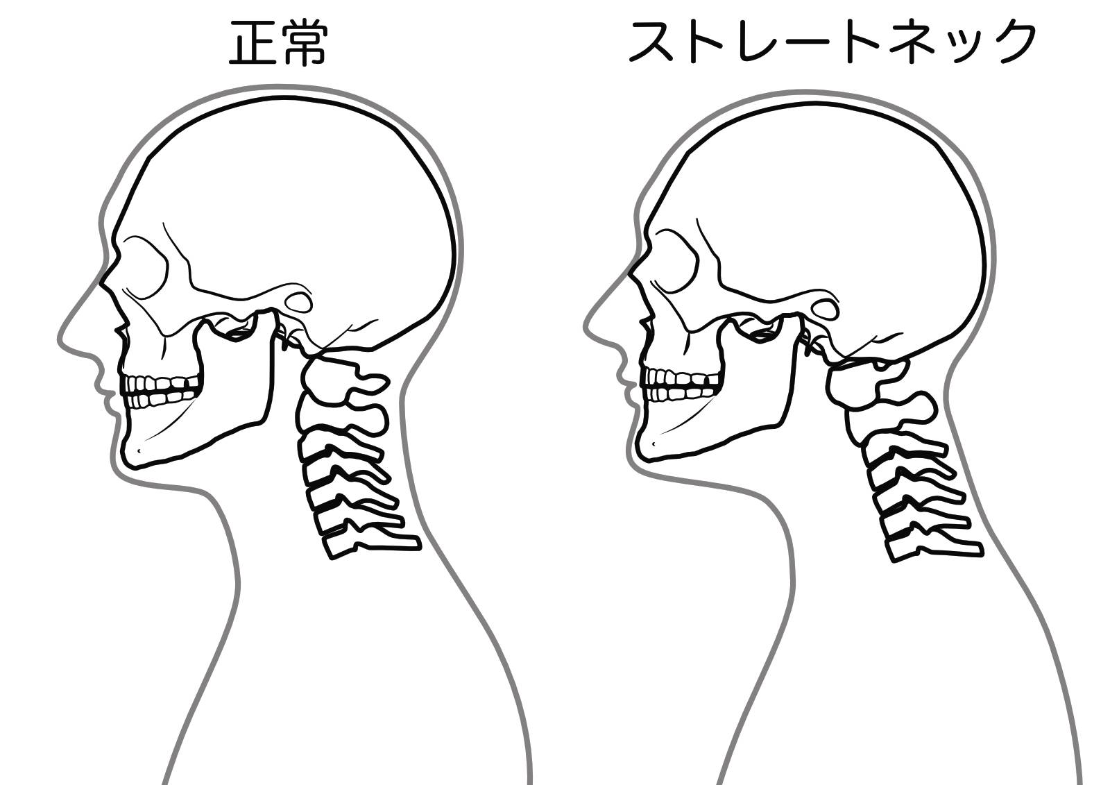 ストレートネック