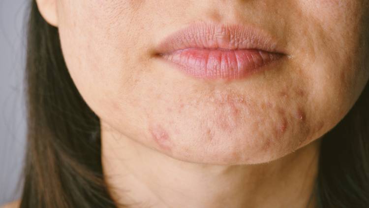 PMSの吹き出物対策！皮膚科専門医が薦める肌ゆらぎの時期のスキンケア