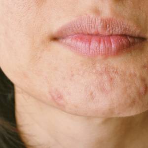 PMSの吹き出物対策！皮膚科専門医が薦める肌ゆらぎの時期のスキンケア