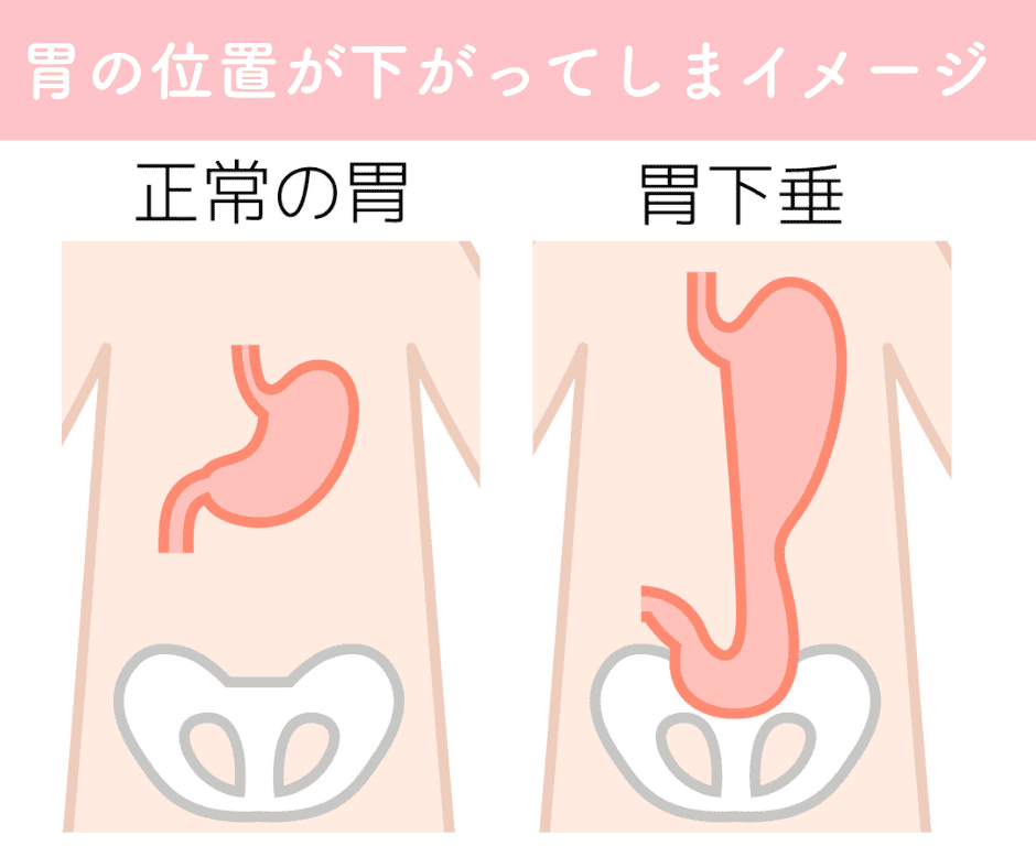 胃下垂のイメージ