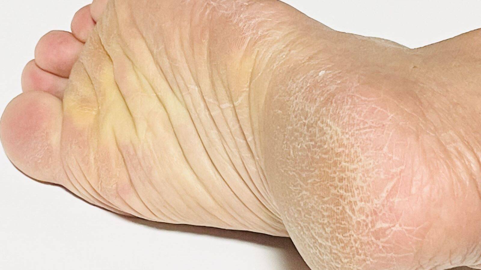 かかとのガサガサは乾燥だけじゃない？実は「骨盤まわりの冷え」のサイン。簡単足もみでポカポカ温活ケア