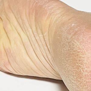 かかとのガサガサは乾燥だけじゃない？実は「骨盤まわりの冷え」のサイン。簡単足もみでポカポカ温活ケア