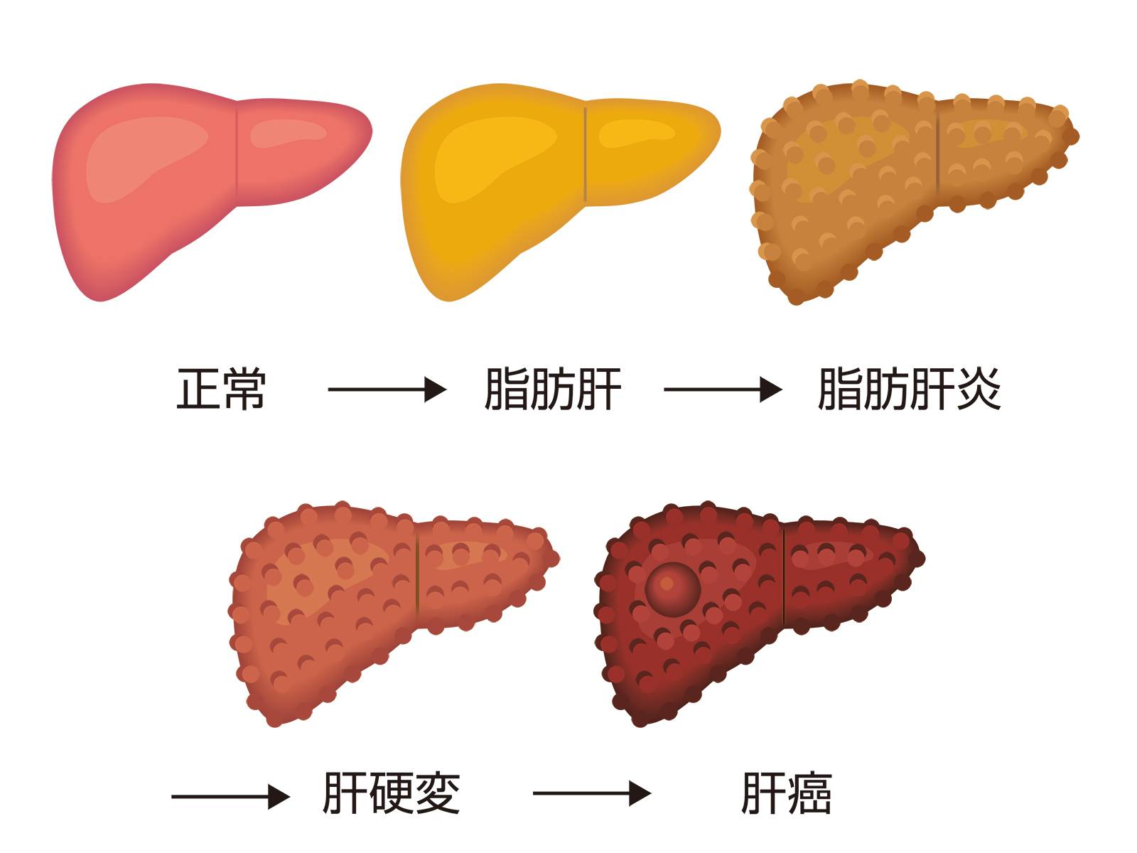 肝臓正常から癌まで