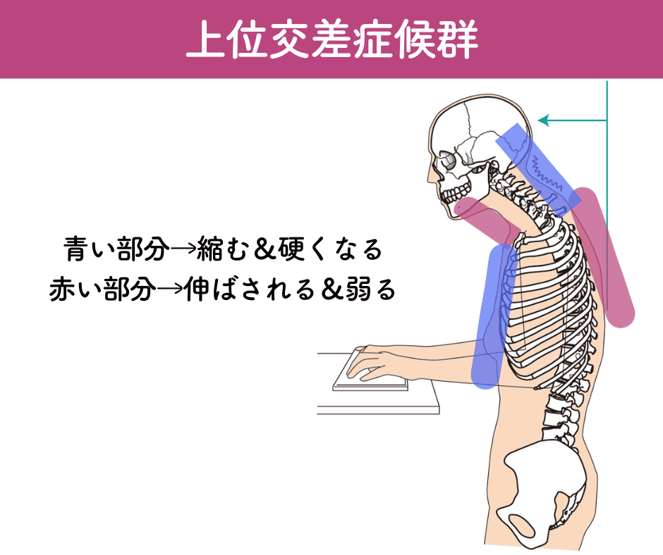 上位交差症候群