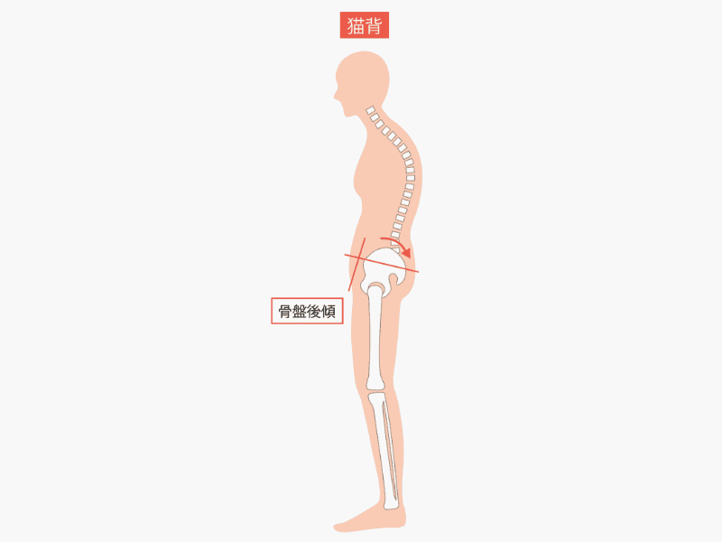 猫背