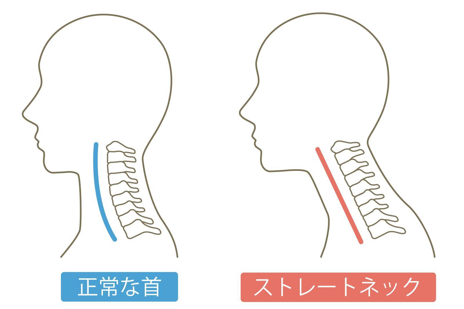 ストレートネック