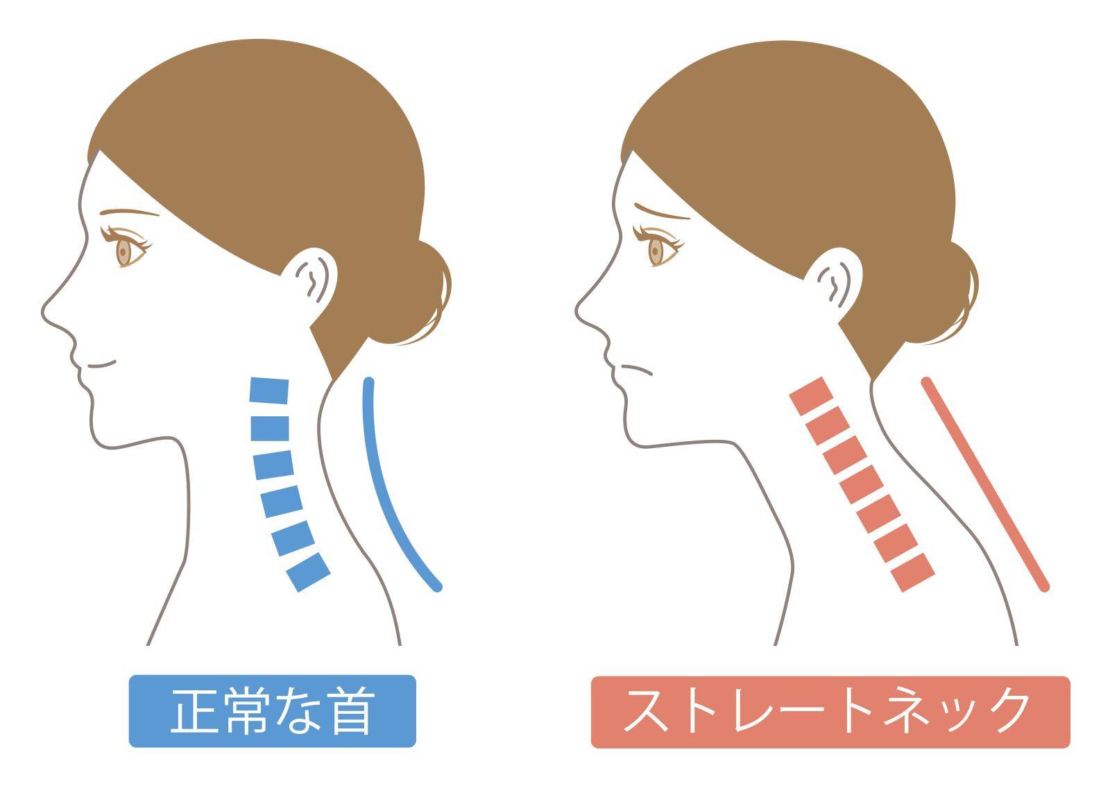 ストレートネック