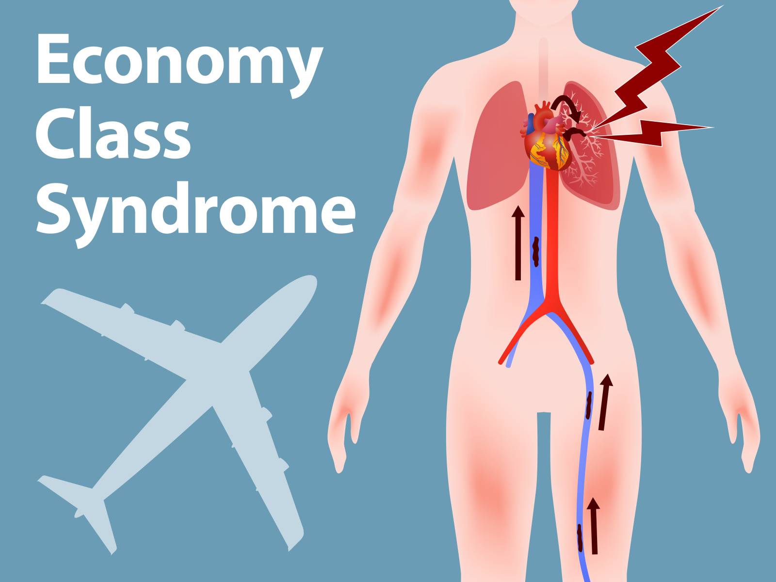 エコノミー症候群