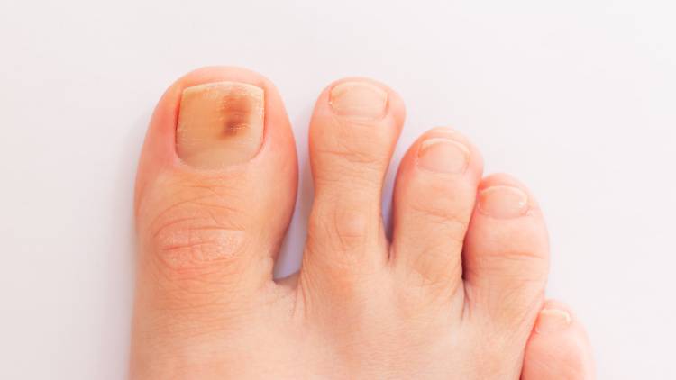 爪に現れる「点状の赤黒い線」…あなたの体に何が起きている？医師が解説