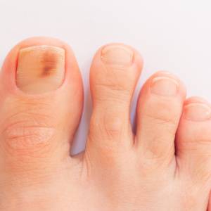 爪に現れる「点状の赤黒い線」…あなたの体に何が起きている？医師が解説