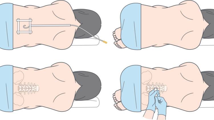 無痛分娩は本当に安全？「硬膜外鎮痛法」の仕組み・安全性・費用を産婦人科医が徹底解説