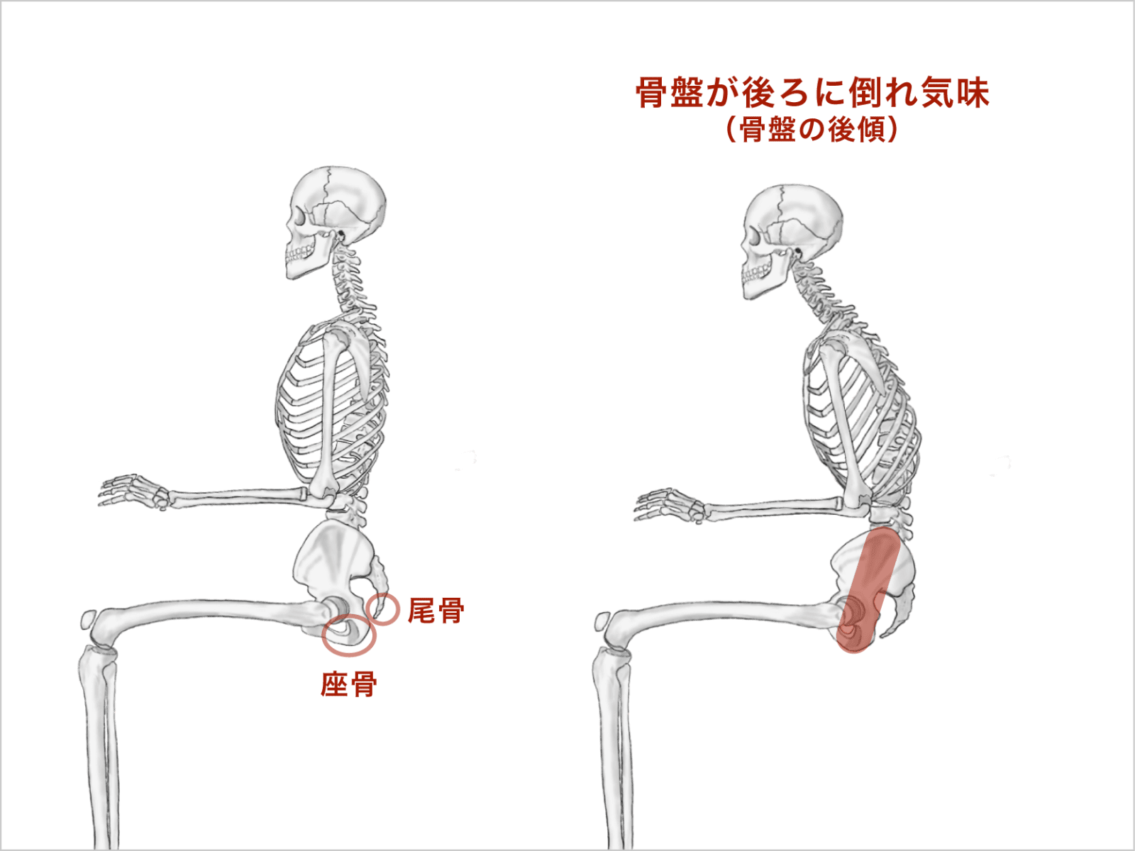 骨盤が後傾している状態