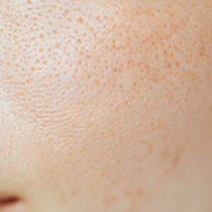 スキンケアより重要？毛穴がじわじわ広がる“NG食習慣”とは｜管理栄養士が解説