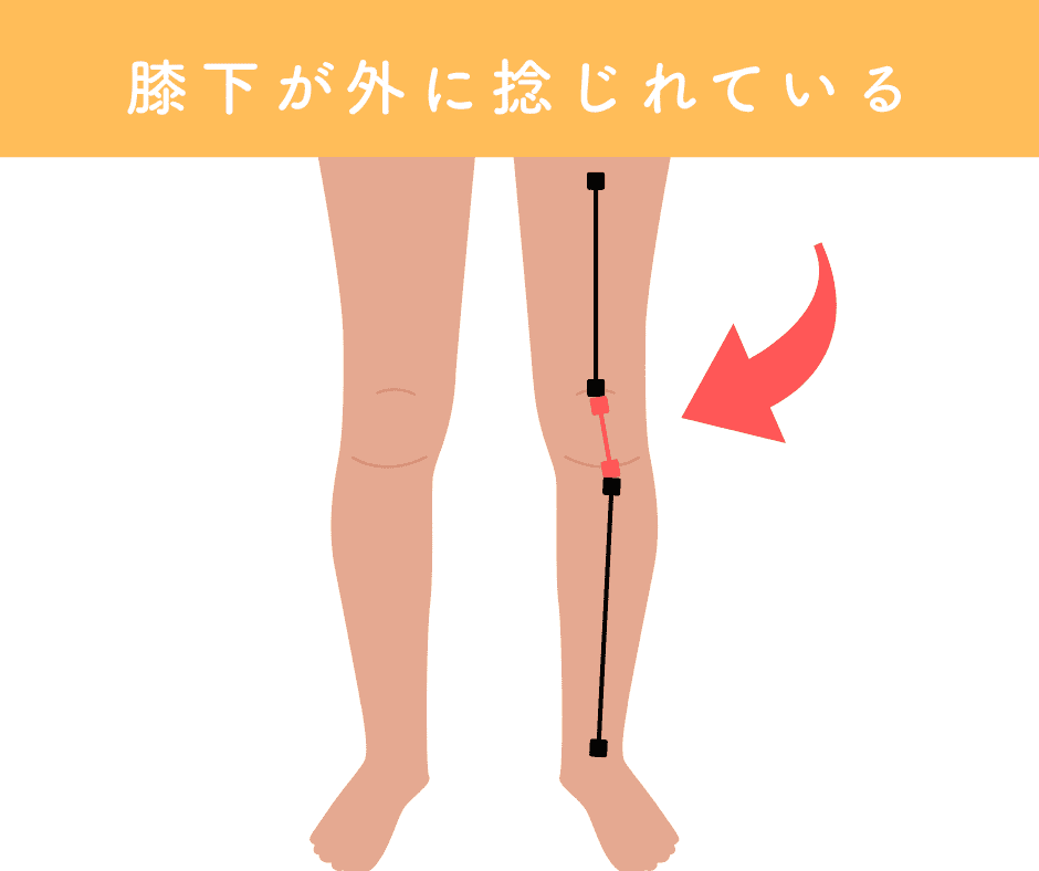 膝下のねじれ