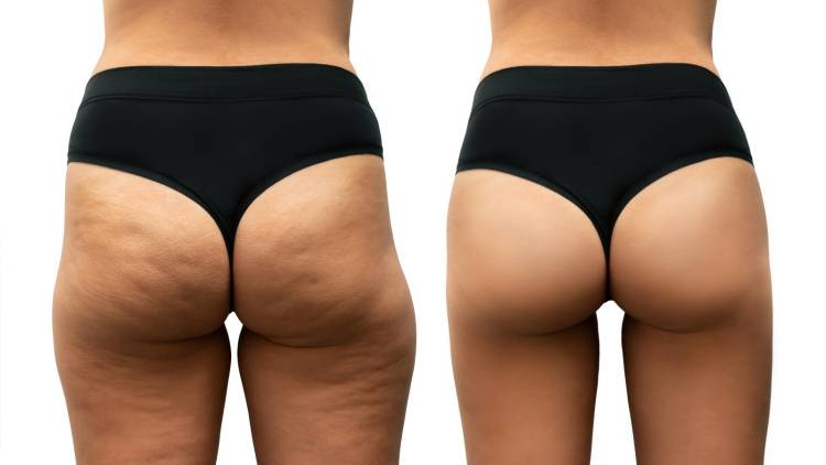 スクワットもランジも効かない垂れ尻にはコレ！四角いお尻を丸く引き上げる「地味トレ」