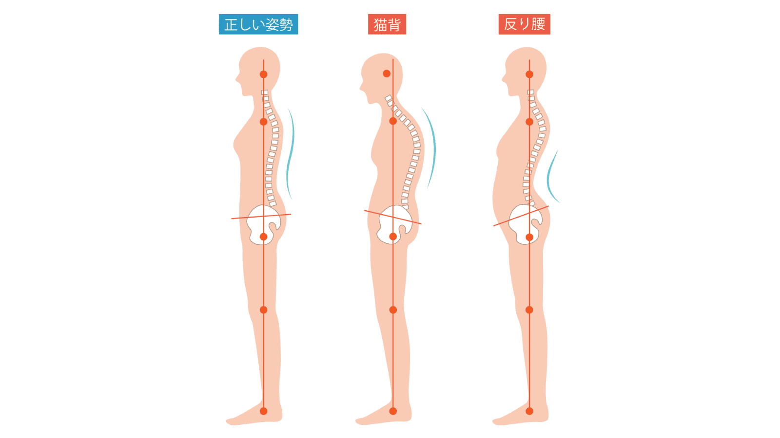 反り腰　猫背　イラスト