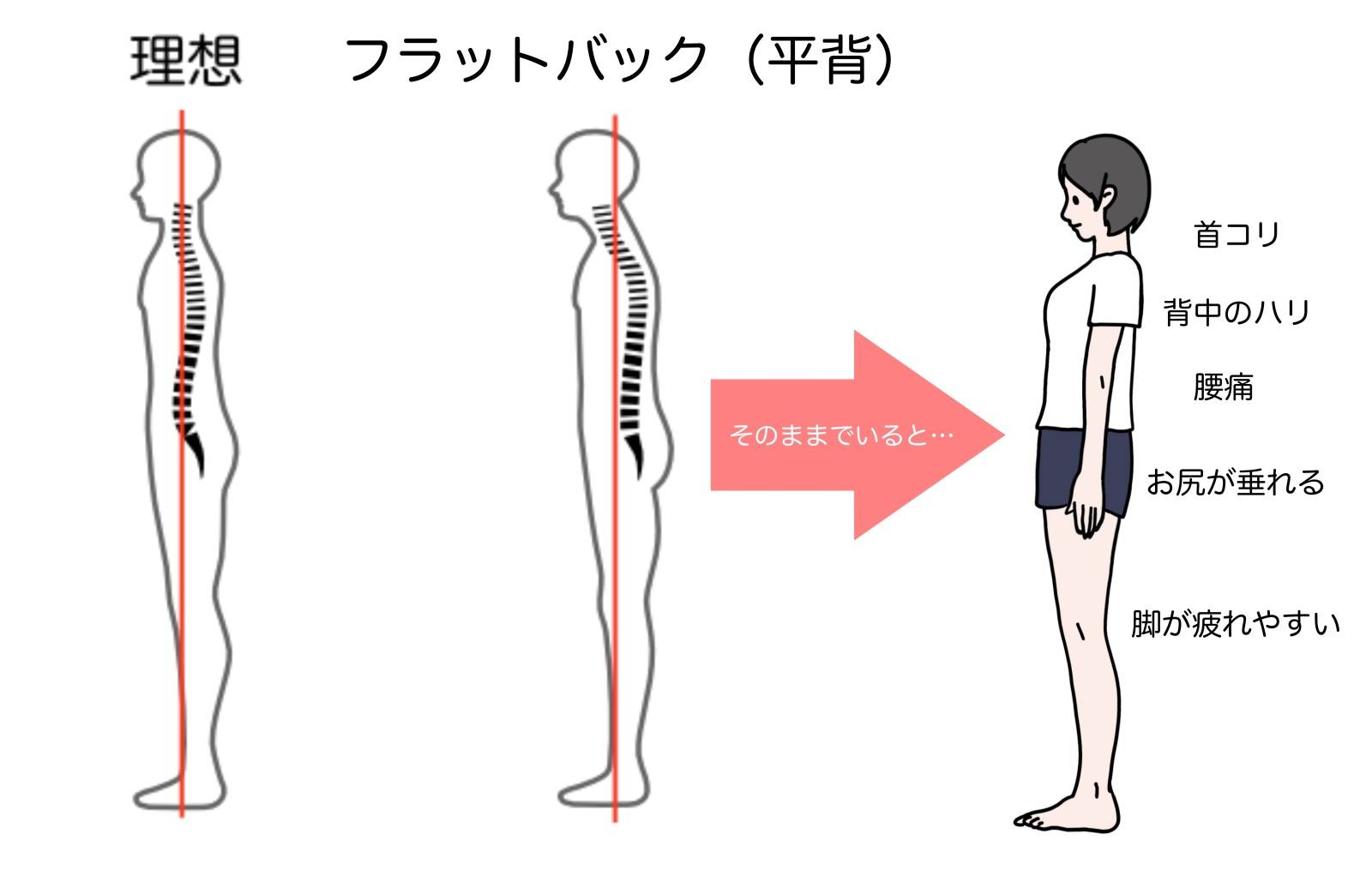 フラットバック