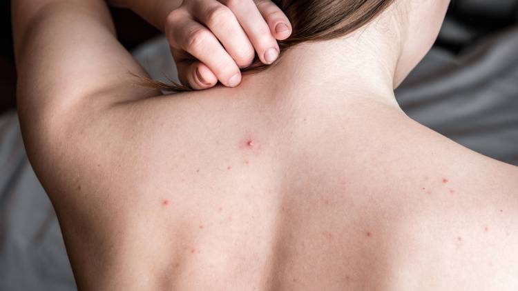 知らずに食べてた…背中のブツブツを増やすNG食品3選｜管理栄養士が解説