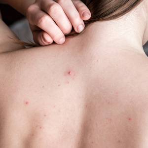 知らずに食べてた…背中のブツブツを増やすNG食品3選｜管理栄養士が解説