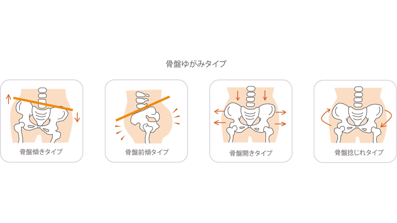 骨盤のゆがみ