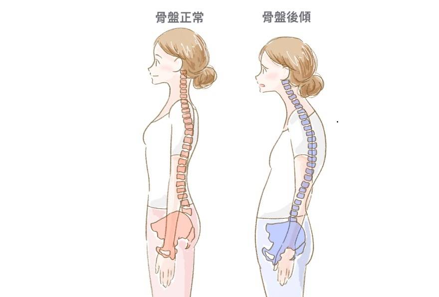 骨盤の後傾