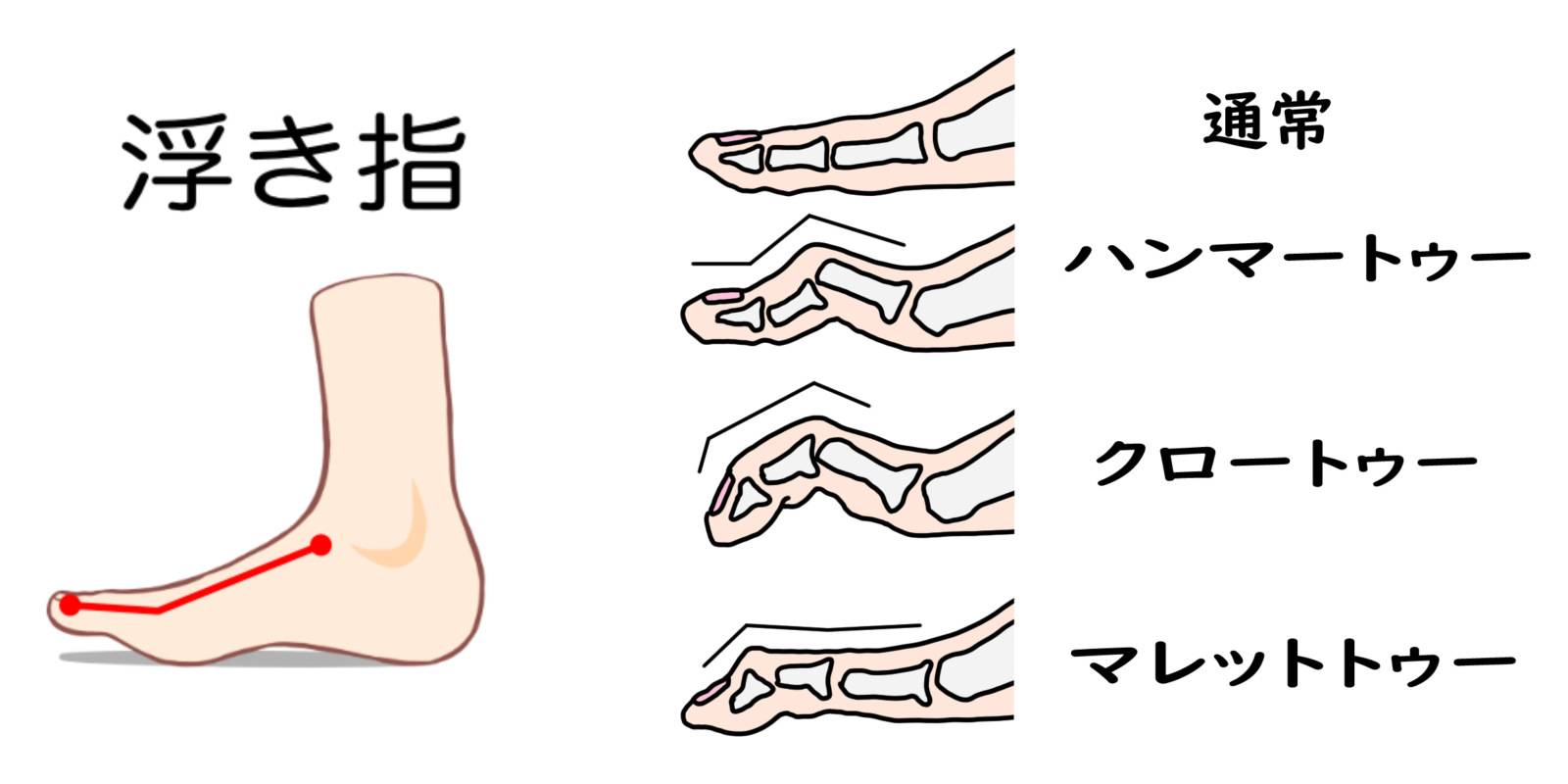 足指の変形