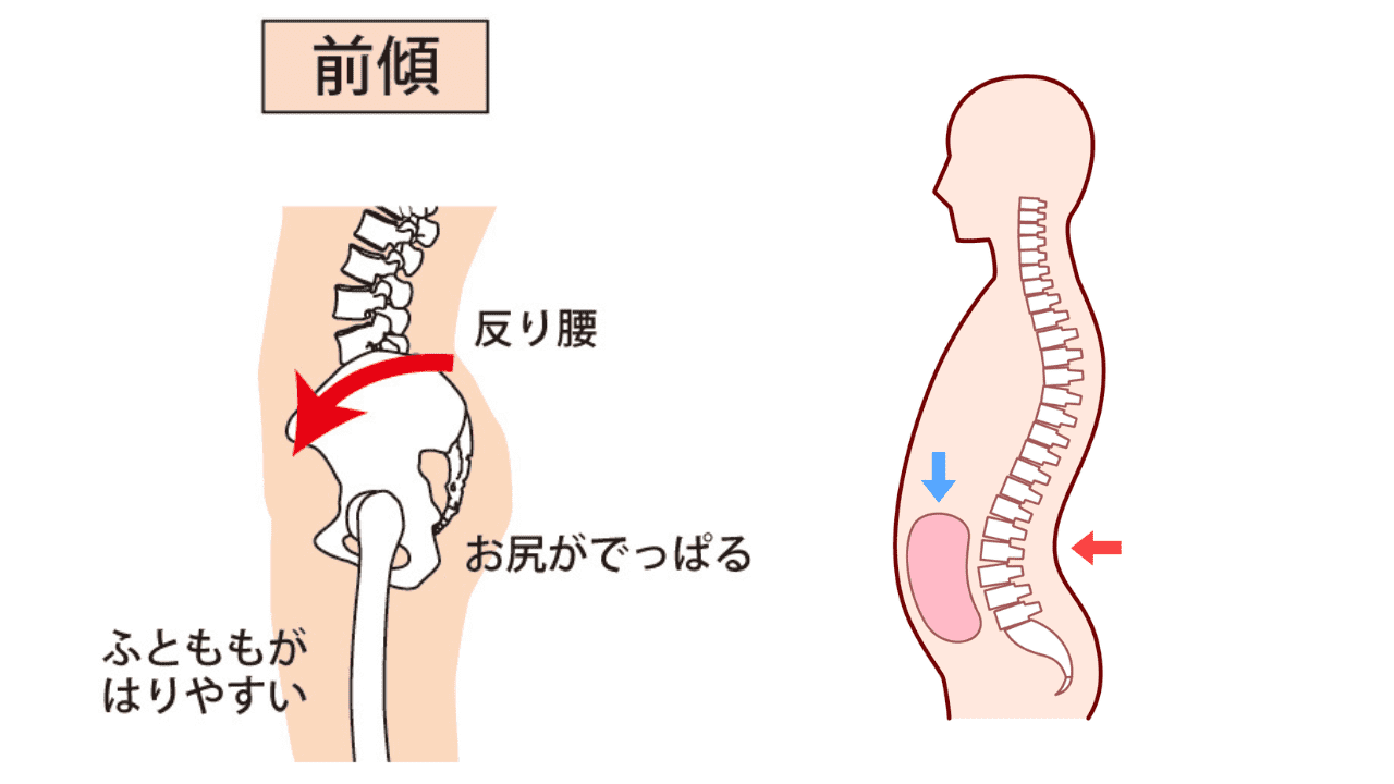 反り腰