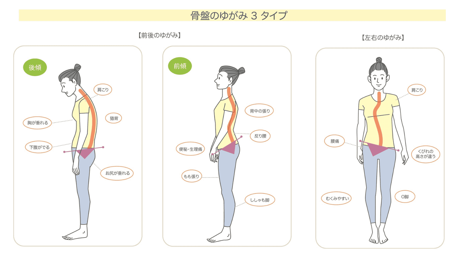 骨盤の歪み