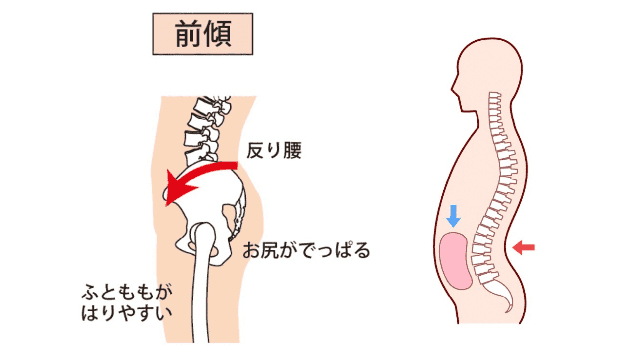 反り腰