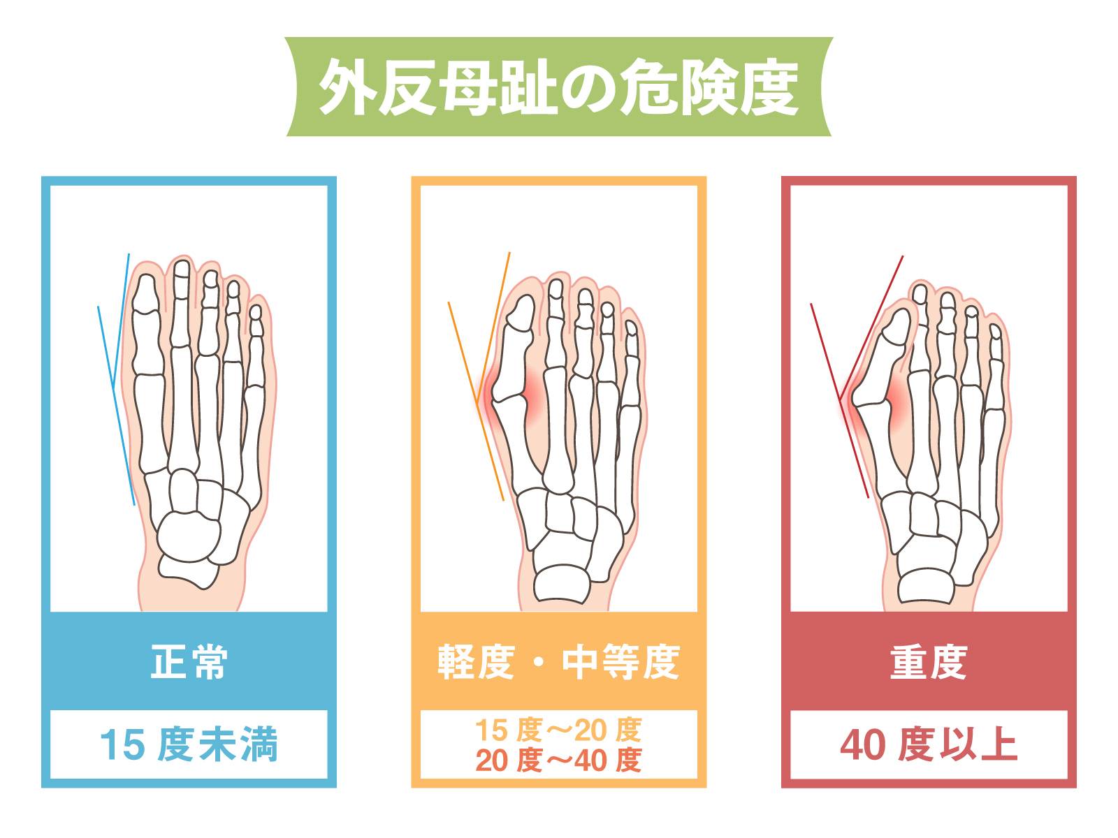 外反母趾