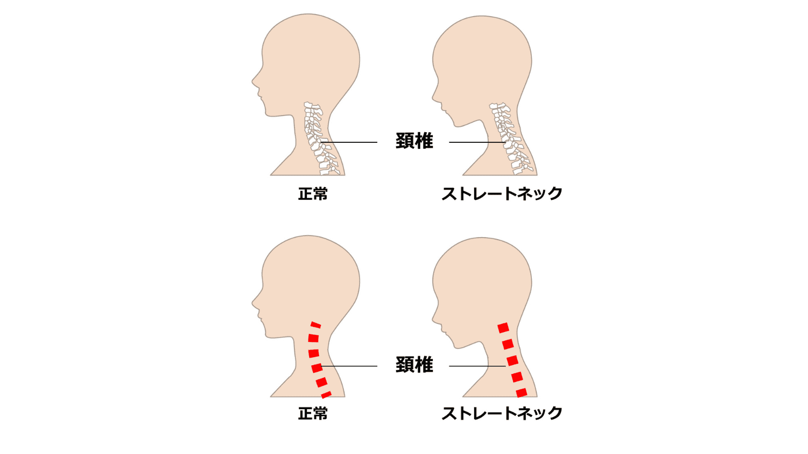 ストレートネック