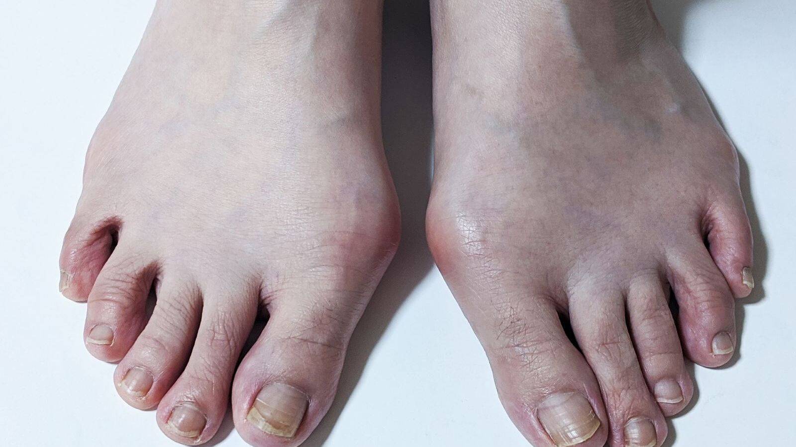 外反母趾で足が痛い【1日30秒】たった2週間の指トレで指の形が改善する！？