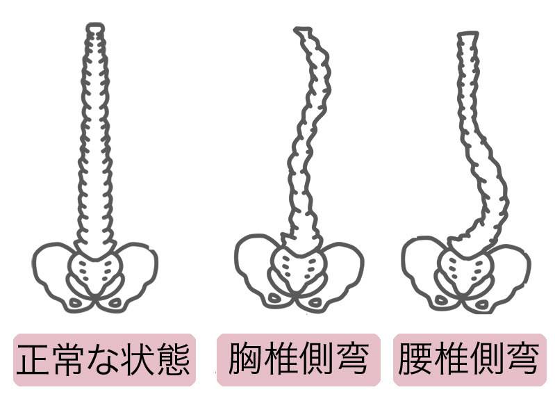 側湾症イメージ
