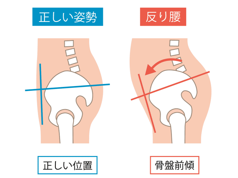 反り腰