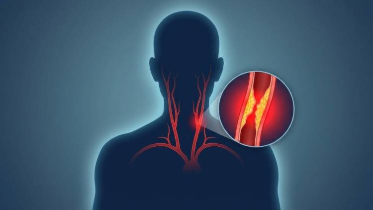 「悪玉コレステロールが正常でも動脈硬化が進む」のはなぜ?注目される血液中のリポ蛋白(a)とは