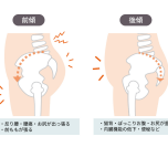 骨盤の歪み